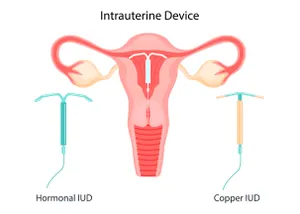 IUD Hormonal dan Non Hormonal, Apa Bedanya?