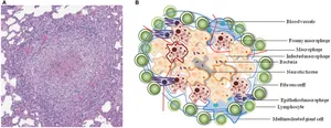 Tuberkulosis (TB)
